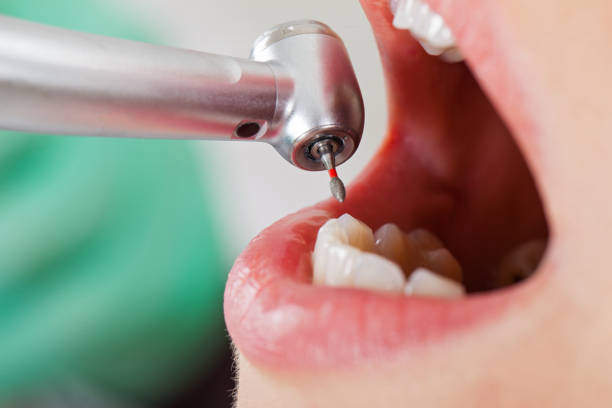 Best Emergency Tooth Extraction in Cordele, GA